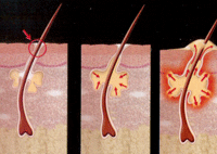 DermaSilk Akne