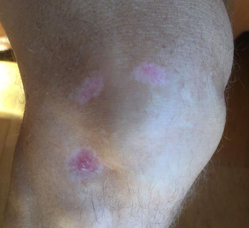 Schürfwunde am Knie mit DermaSilk behandelt