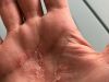 Psoriasis an der Hand