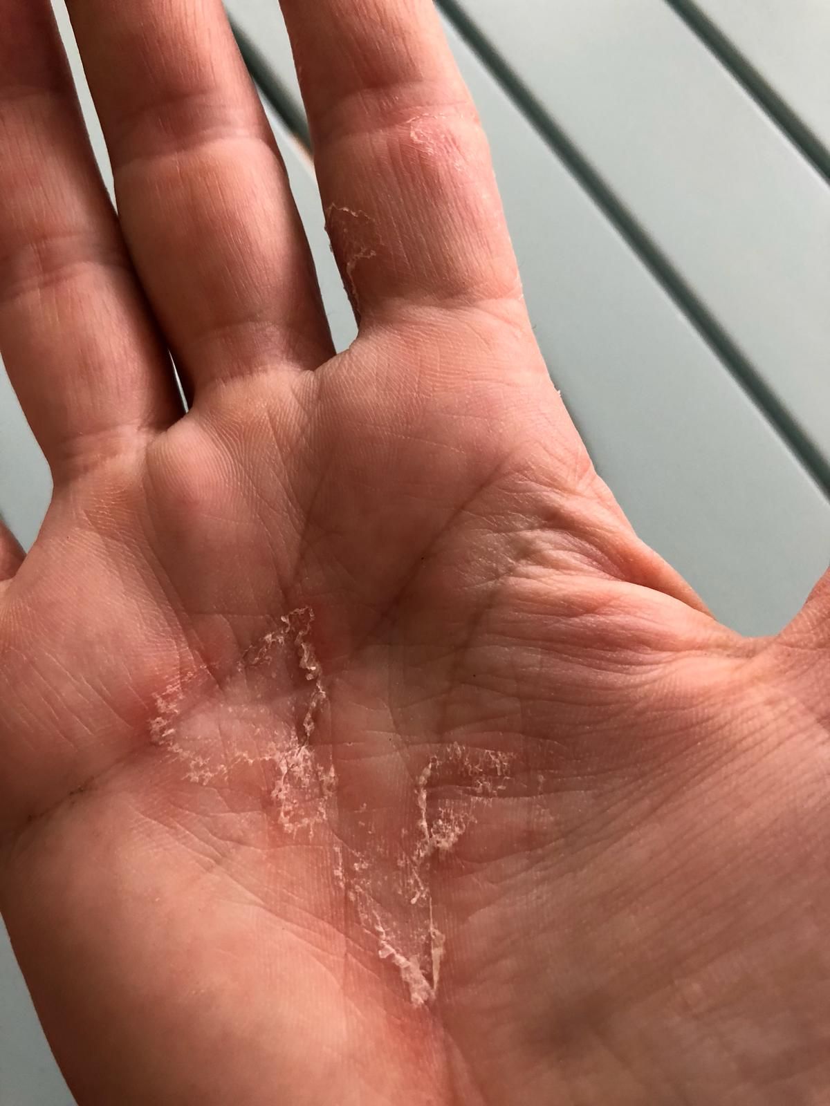 Psoriasis an der Hand