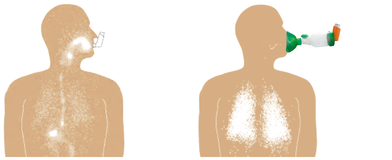 Inhalation mit und ohne Vorschaltkammer